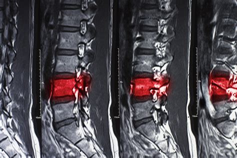 vertebral compression fracture months pain